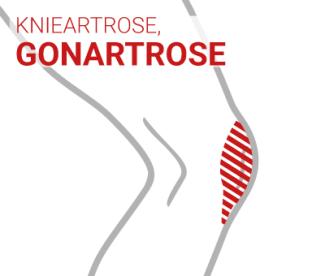 KNIEARTROSE, GONARTROSE